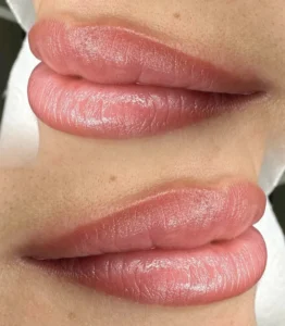 How Can I Speed Up Lip Healing?